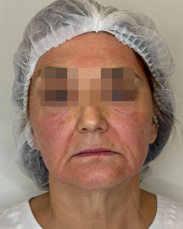 ALMA HYBRID, фото пациента после