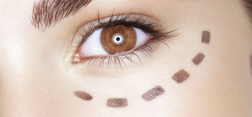  Подглазничные имплантаты 