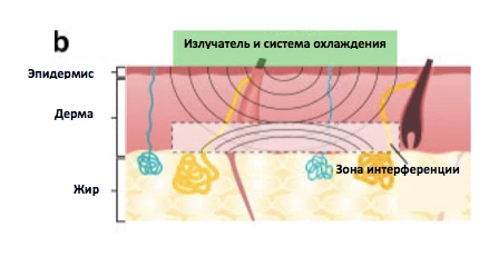 лечение гипергидроза на аппарате MiraDry