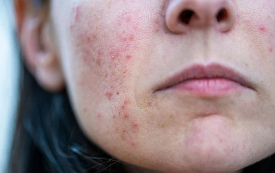 Криомодуляция уменьшает симптомы розацеа
