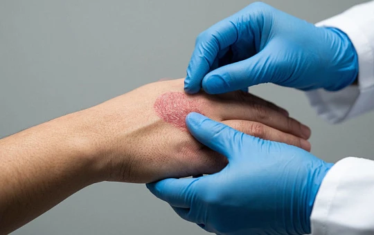 Три в одном: ученые обнаружили, как белки повреждают клетки кожи при псориазе
