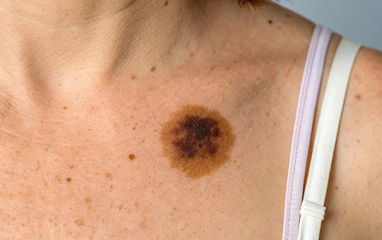 Меланома: научные данные весны-2022