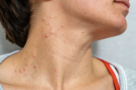 Ошибки, которые сложно исправить: как бороться с осложнениями мезотерапии