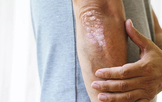 Низкий уровень тестостерона и недосып повышает риск развития псориаза у мужчин