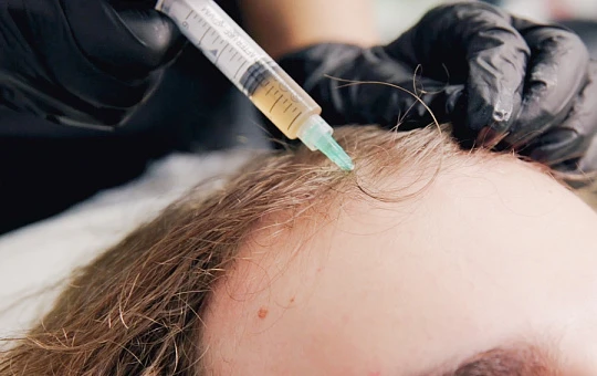 PRP-терапия + ортокремниевая кислота против андрогенной алопеции