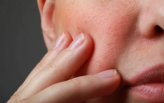 Сочетание микронидлинга, IPL и гидролифтинга эффективнее монотерапии