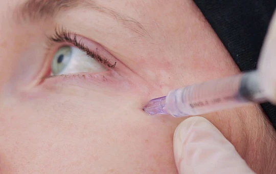 Новое устройство для биоревитализации Micro-Needle эффективнее и комфортнее классического метода