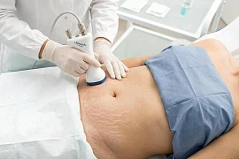 Biodermogenesi<sup>®</sup>: бережная регенерация против стрий и рубцов