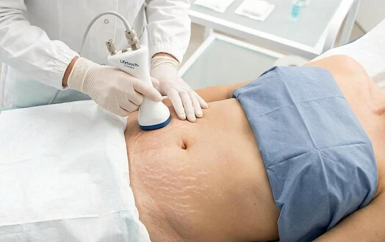Biodermogenesi®: бережная регенерация против стрий и рубцов
