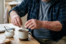 Образ жизни влияет на самочувствие пациентов с псориазом