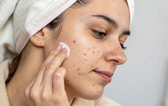 Новые данные о связи между комедогенной косметикой и акне