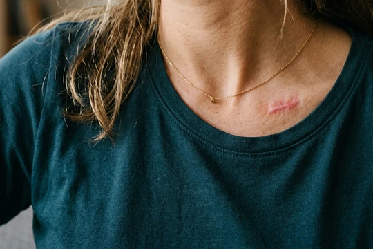 Комбинация лазеров лучше монотерапии при гипертрофических рубцах