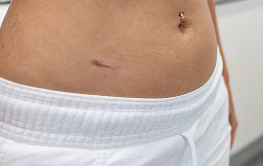 Экзосомы улучшают состояние послеоперационных рубцов