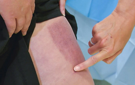 В Австралии проводят первое в мире клиниспытание 3D-печатной кожи