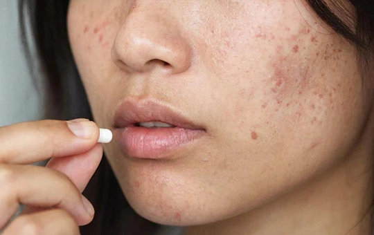 Изучены новые методы терапии акне