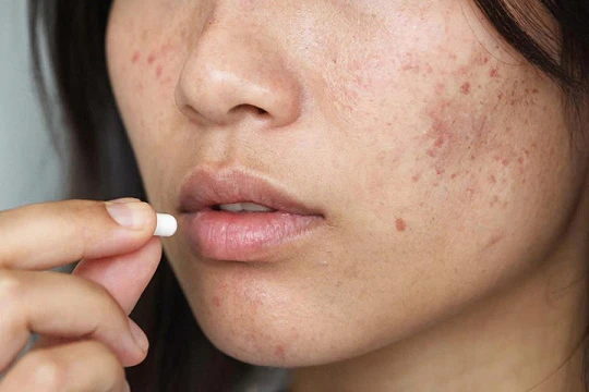 Изучены новые методы терапии акне