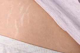 Эффективная коррекция стрий