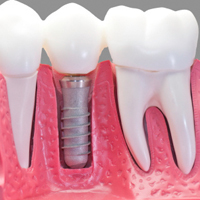Имплантация зубов – интересно об известном
