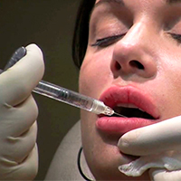 Juvederm Ultra XC для контурной пластики губ Juvederm Ultra XC для контурной пластики губ