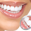 Отбеливание зубов: мифы и факты