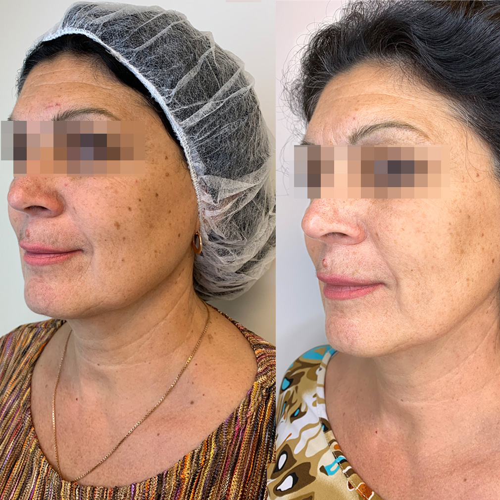 Kiara Reju применяют для сияния и регенерации кожи дополненное ПДРН и ...