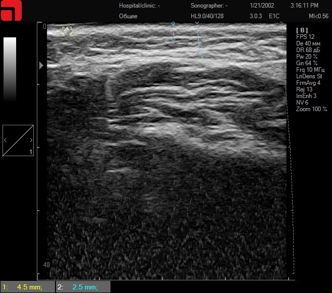 Строение кожи, подкожно-жировой клетчатки и смас в щечной области