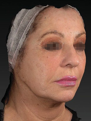 Косая и боковая проекции лица