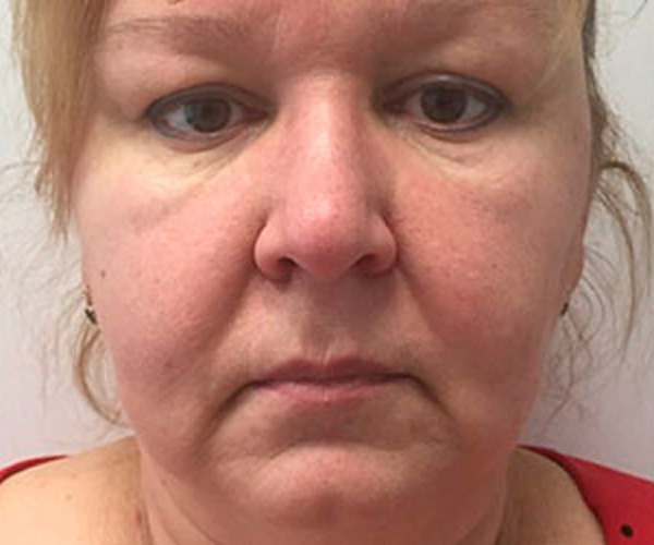 Микротоковый дренаж против малярных мешков