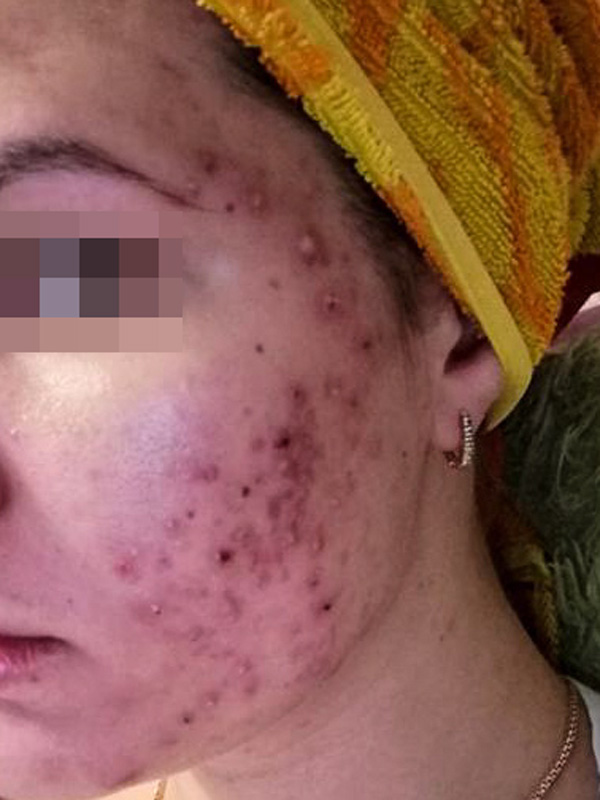 Комбинированная терапия акне