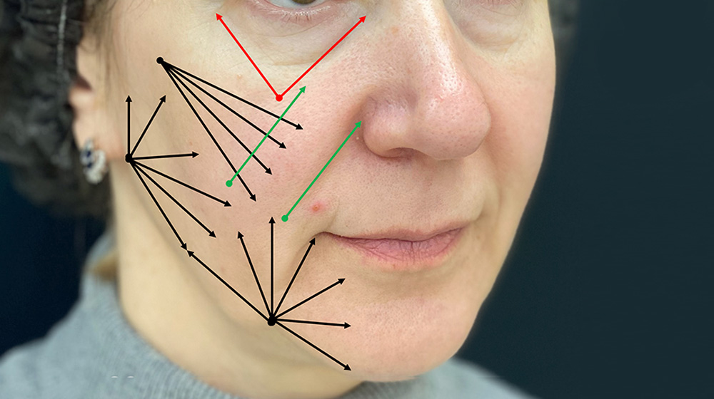 Схема введения препарата MIRACOLL filler