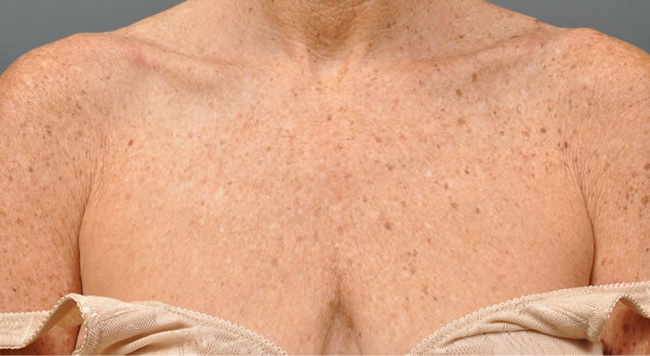 Ultherapy декольте, фото до