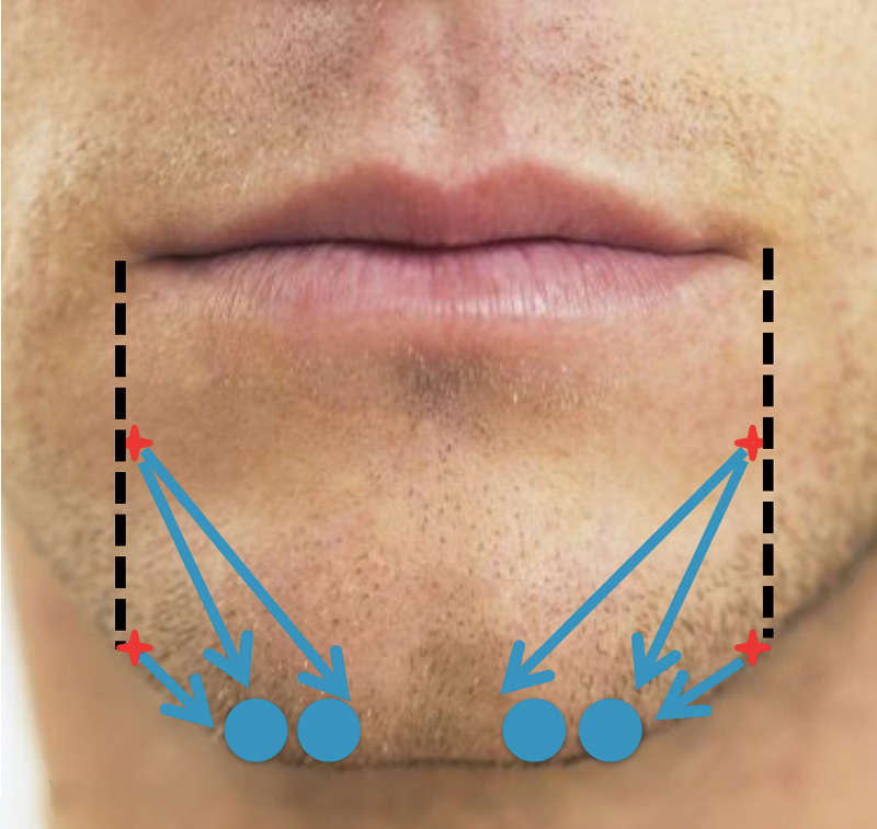 коррекция подбородка, разметка, Restylane Perlane