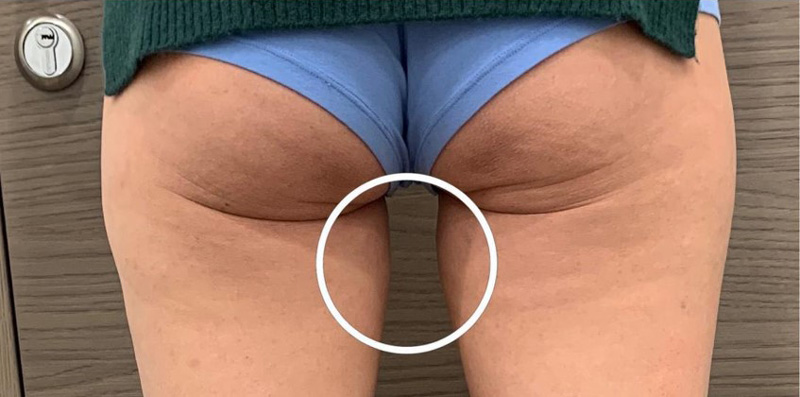 SLIMUS, фото до и после