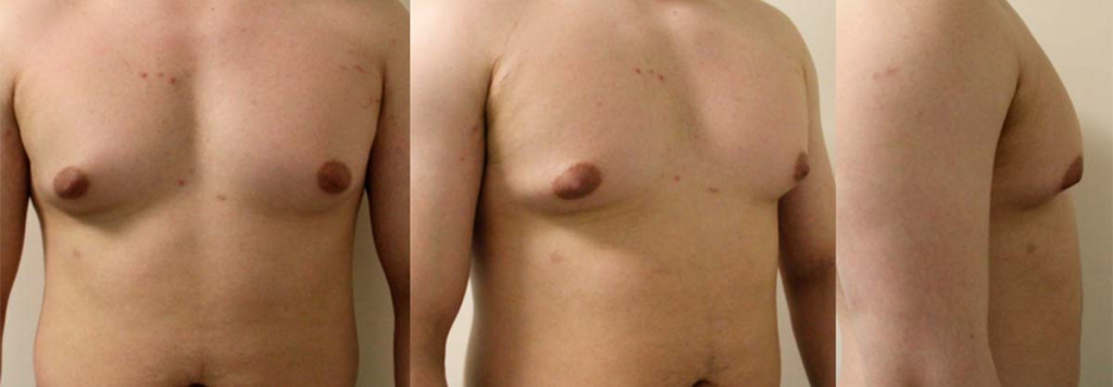 Фото до процедуры DEKA SmartLipo do_mastektomii_DEKA-SmartLipo