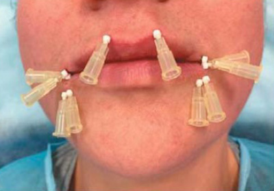 Микронити DG-lift (31G, 30G)