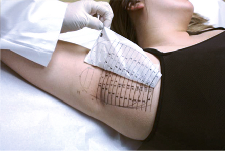 лечение гипергидроза на аппарате MiraDry