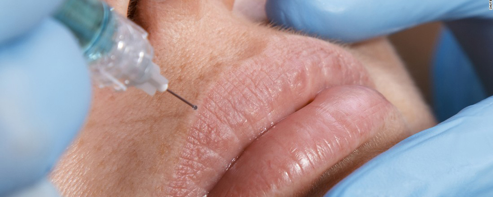 Биопленки при введении филлеров