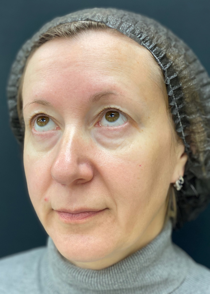 До проведения процедуры с препаратом MIRACOLL fille