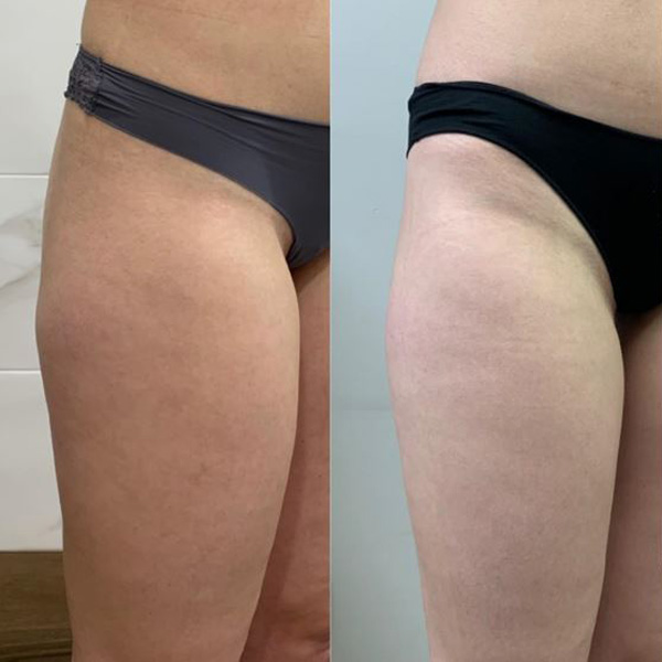 SLIMUS, фото до и после