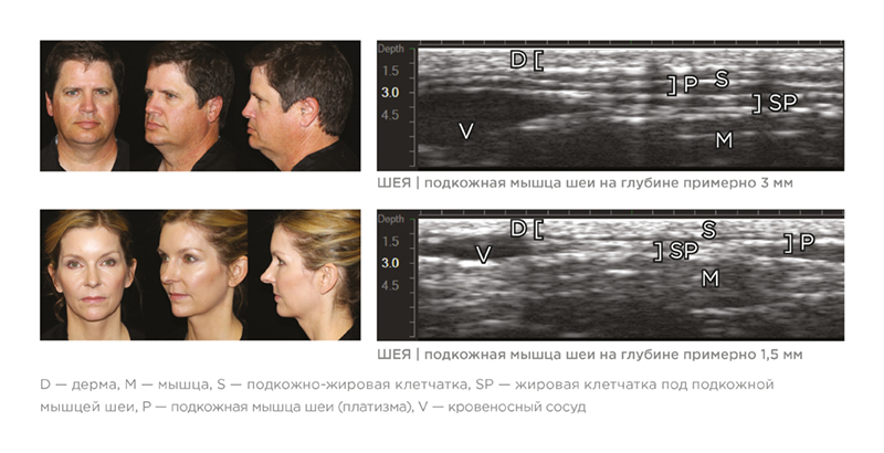 Визуализация на аппарате Ulthera® System