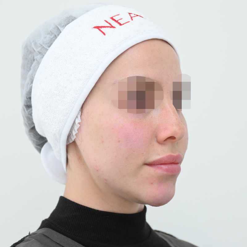 Процедура Fresh&Lift, фото после