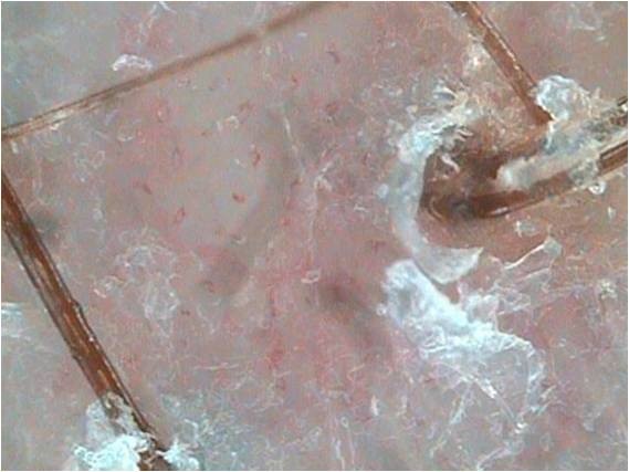 Себорейный дерматит Себорейный дерматит
