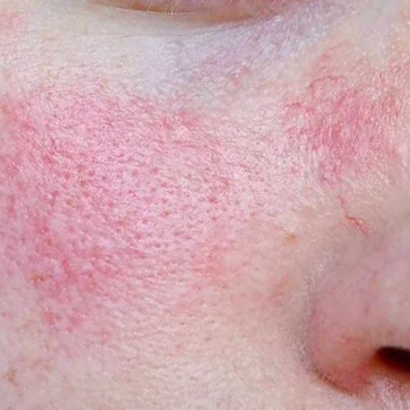 Клинический случай: розацеа