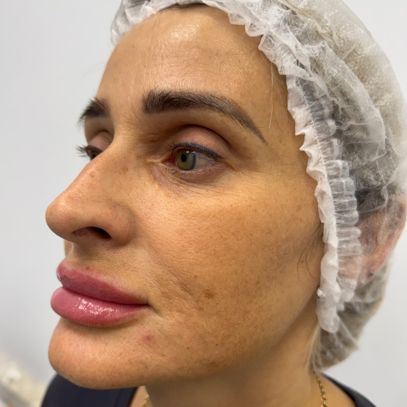 CO₂ лазер + Cellenis PRP, фото До