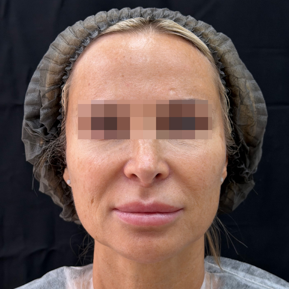 Oligio и Neauvia: фото до