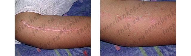Z-plastika rubcy-keloid1-2.jpg