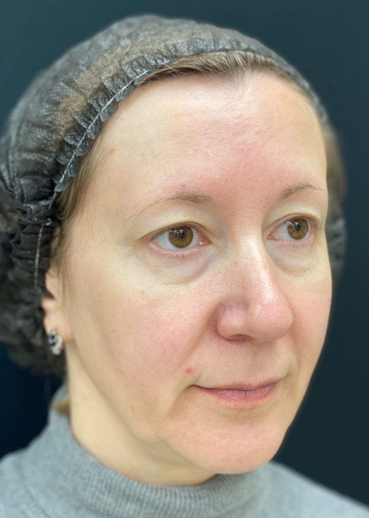 До проведения процедуры с препаратом MIRACOLL fille