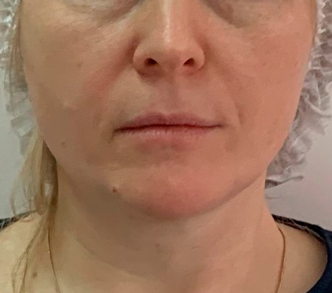 Асимметрия лица – асимметрия SMAS