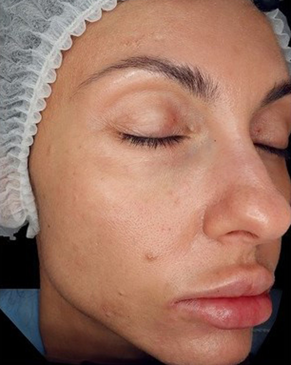 Calecim Professional Serum
