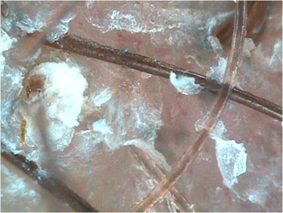 Себорейный дерматит и алопеция Себорейный дерматит и алопеция
